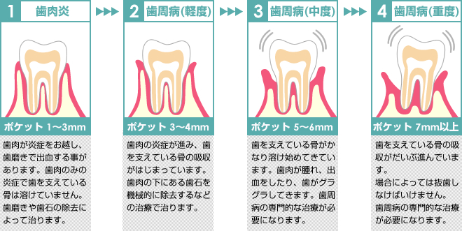 歯周病治療